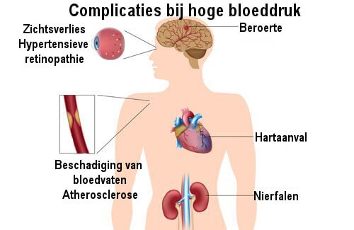 Complicaties hoge bloeddruk